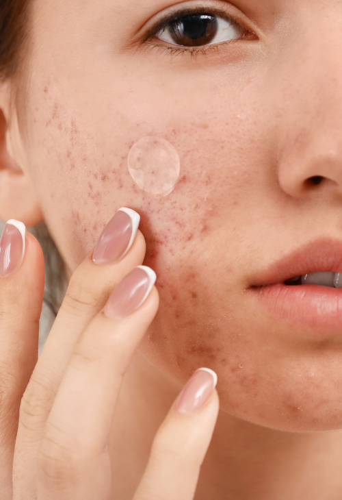 Bemutatjuk az Anti-Akne Mentor Programot